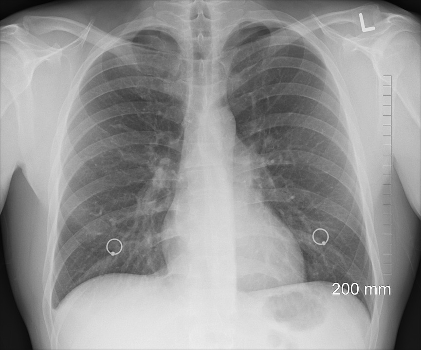 radiografía torax adulto mayor