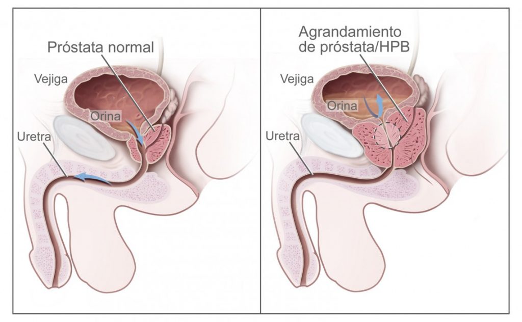 Se muestra la sintomatologia de la Hiperplasia Prostática Benigna