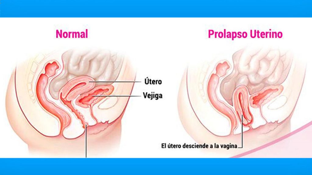 Se muestra el estadio normal y un prolapso uterino en una mujer adulta mayor